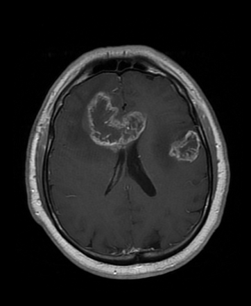 Multicentric glioblastoma | Radiology Reference Article | Radiopaedia.org