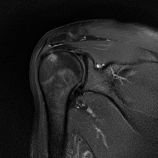 Quadrilateral space syndrome | Image | Radiopaedia.org