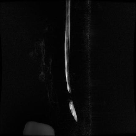 Lumbar disc protrusion | Radiology Case | Radiopaedia.org