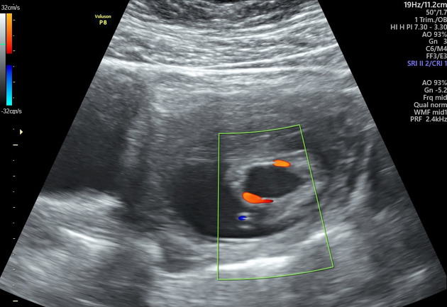 Echogenic fetal kidneys and megacystis, Radiology Case