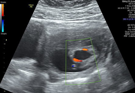 Echogenic fetal kidneys and megacystis | Radiology Case