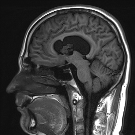 Subependymal giant cell astrocytoma (SEGA) | Image | Radiopaedia.org