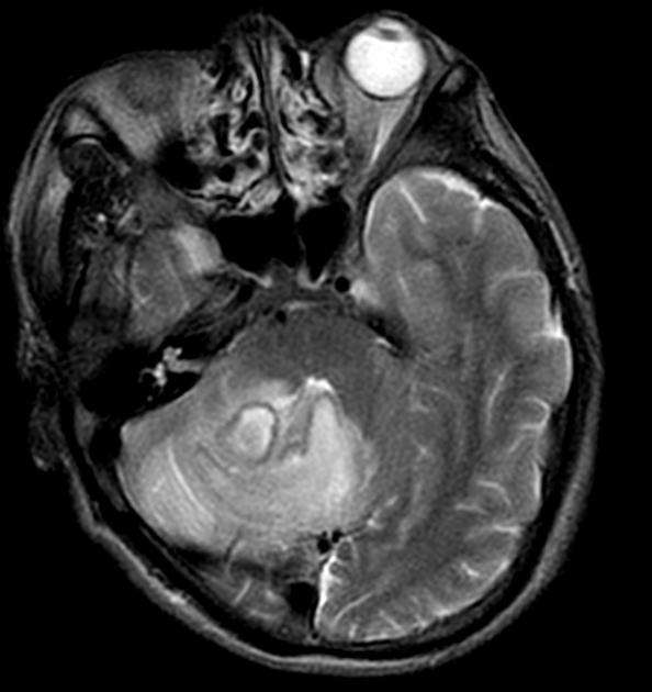 Cerebellar abscess (MR spectroscopy) | Image | Radiopaedia.org