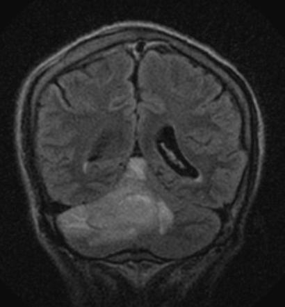 Cerebellar abscess (MR spectroscopy) | Image | Radiopaedia.org