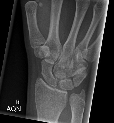 Pronator fat pad sign with a subtle distal radial fracture | Image ...