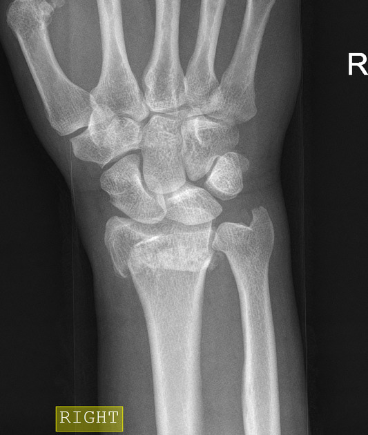 Colles fracture, Radiology Case