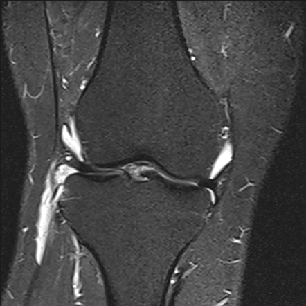 Pivot shift knee injury- ACL tear and Ramp meniscal lesion | Image ...