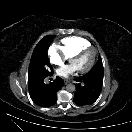 Saddle pulmonary embolism with right ventricular strain and right ...