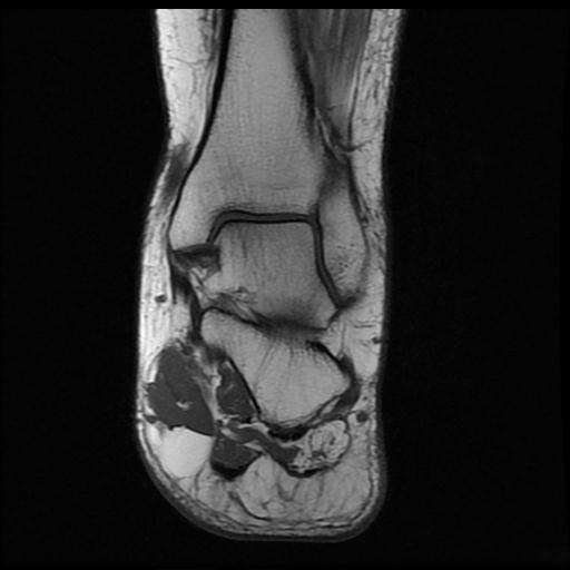 Baxter’s nerve impingement | Image | Radiopaedia.org