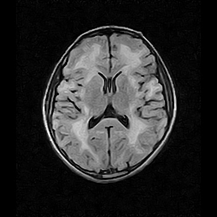 Cystic leukoencephalopathy without megalencephaly | Radiology Case ...