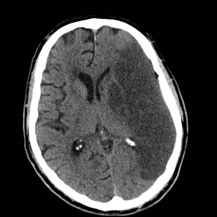 Stroke Progression On CT Radiology Case Radiopaedia Org   476329972f019f656bed02edf069cf Gallery 