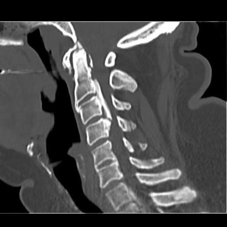 calcification du ligament longitudinal antérieur