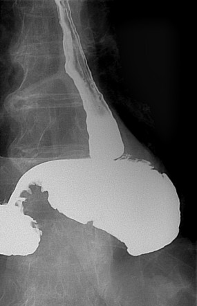 Organoaxial gastric volvulus | Image | Radiopaedia.org