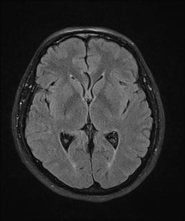 Medulloblastoma - Adult | Radiology Case | Radiopaedia.org