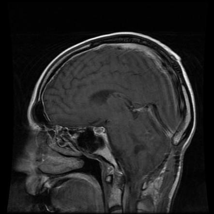 Medulloblastoma - adult | Image | Radiopaedia.org