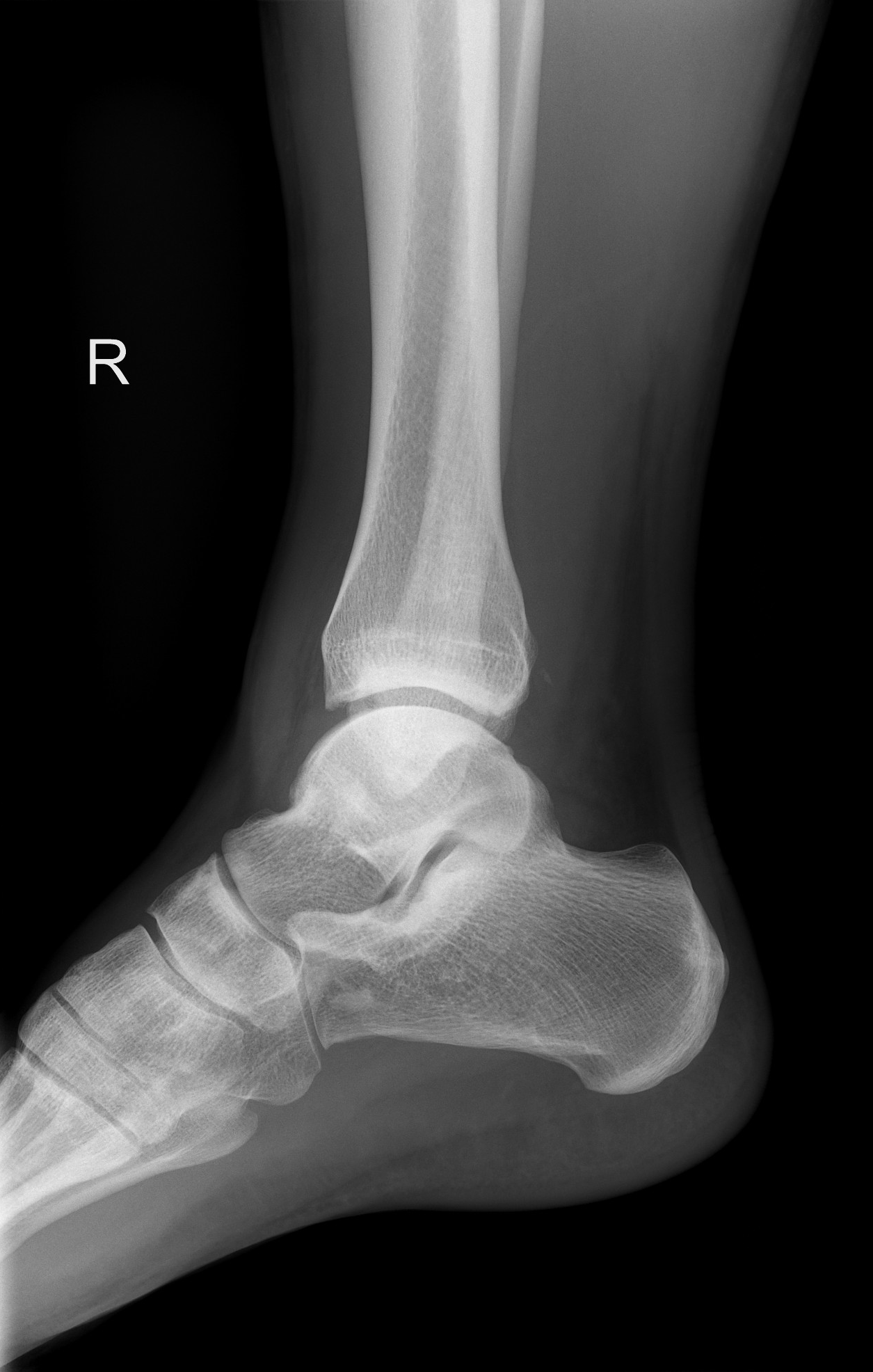 Medial malleolus avulsion fracture | Image | Radiopaedia.org