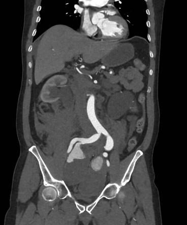 Ruptured internal iliac artery aneurysm | Radiology Case | Radiopaedia.org