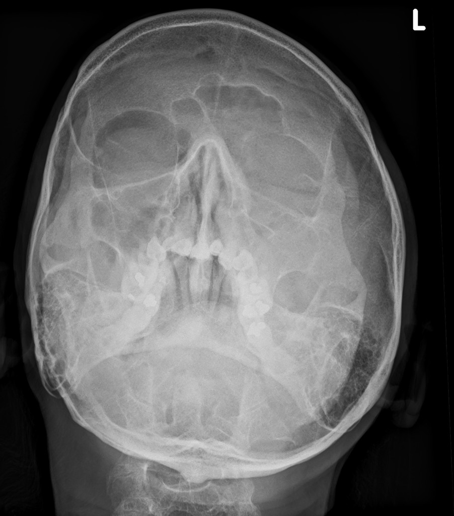 Orbital Fracture X Ray