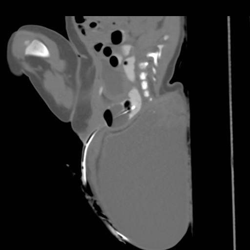 Sacrococcygeal Teratoma Image