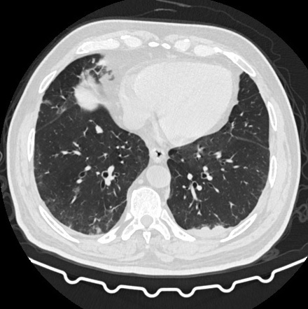 Pulmonary and pleural metastases from renal neoplasm | Radiology Case ...