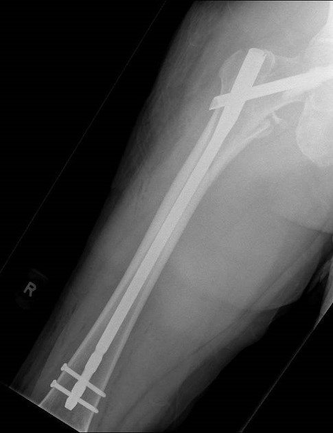 a) AP X-ray showing fixation of a A3 distal femoral fracture with nail... |  Download Scientific Diagram