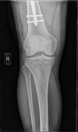 Proximal femoral nailing for intertrochanteric fracture | Image ...