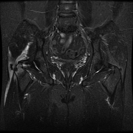 Calcific Tendinitis Of The Gluteus Medius Radiology Case