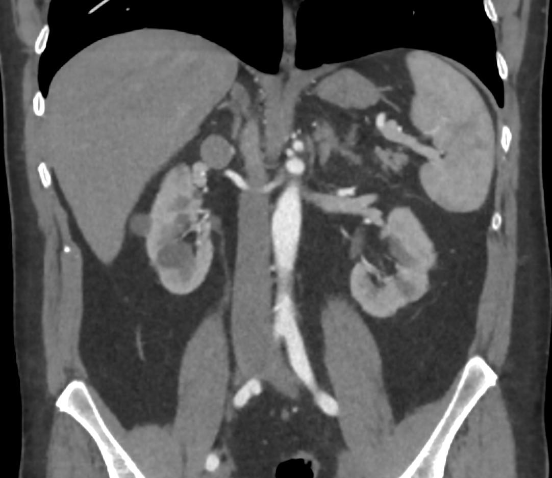 Absent Celiac Trunk Image Radiopaedia Org