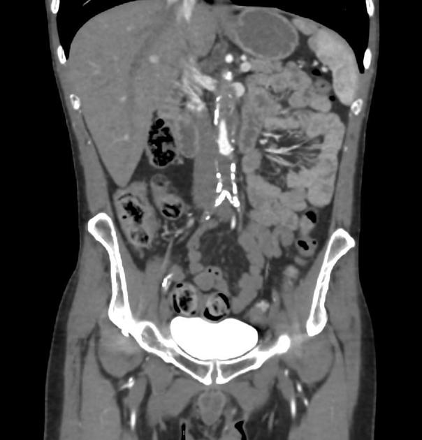 Aortoiliac occlusive disease Radiology Reference Article