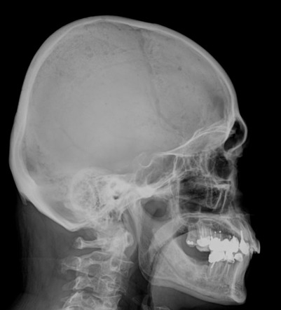 Multiple Myeloma Radiology Reference Article Radiopaedia Org