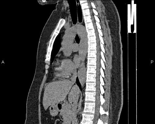 Right sided aortic arch | Image | Radiopaedia.org