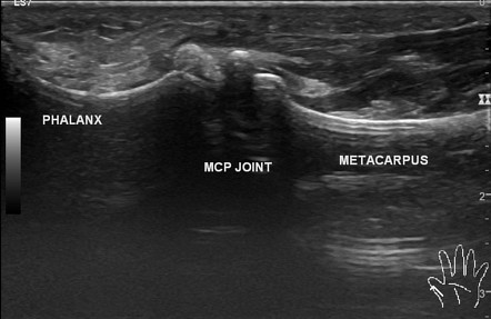 Acute Calcific Periarthritis 