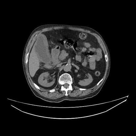 Acute Calcular Cholecystitis | Radiology Case | Radiopaedia.org