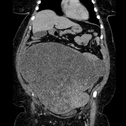 Benign leiomyoma with hydropic features | Radiology Case | Radiopaedia.org