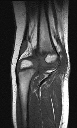 Congenital Knee Dislocation | Radiology Case | Radiopaedia.org