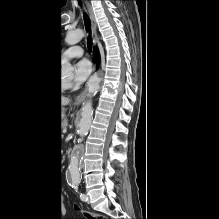 Tuberculosis Spondylodiscitis - Dorsal Spine | Radiology Case ...