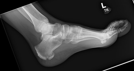 Medial process calcaneal fracture | Image | Radiopaedia.org