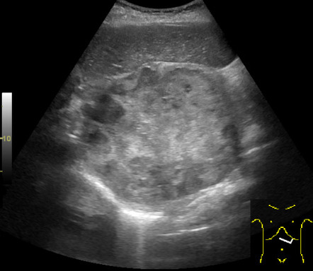 Phaeochromocytoma | Radiology Case | Radiopaedia.org