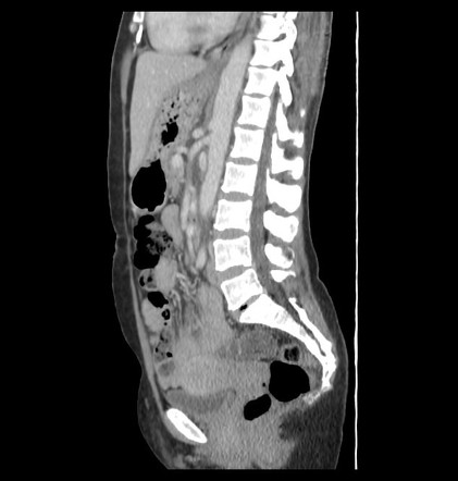 Pheochromocytoma | Image | Radiopaedia.org