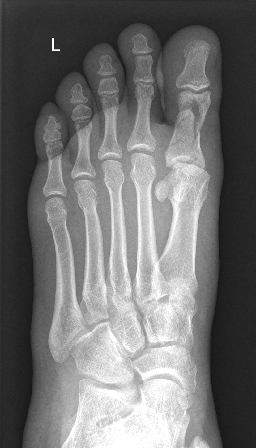 Comminuted fracture - proximal phalanx of the 1st toe | Image ...