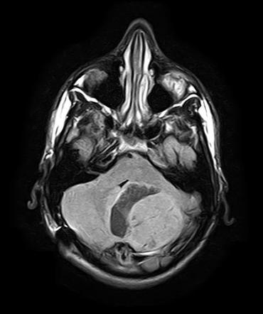 Pilocytic astrocytoma | Radiology Case | Radiopaedia.org