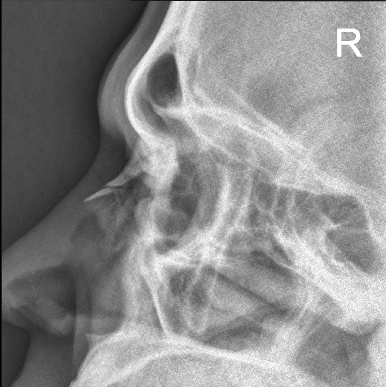 Nasal bone fracture Image