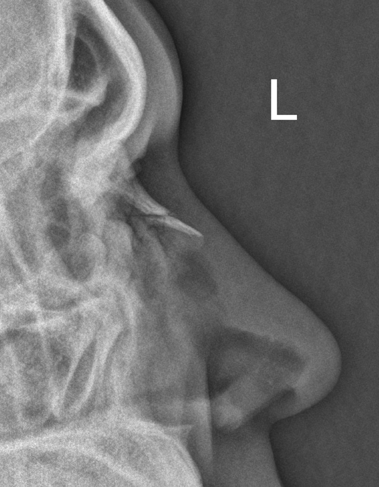 Nasal bone fracture Image