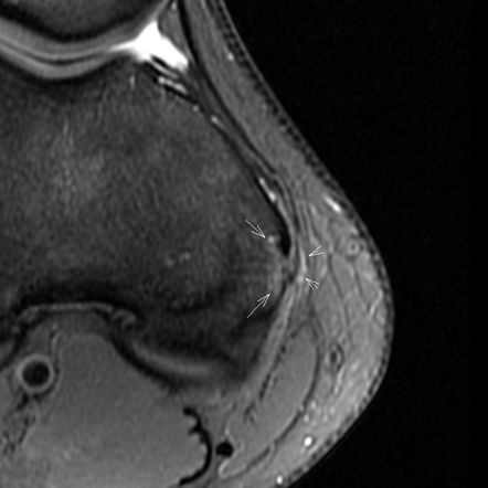 Posteromedial corner injury of the knee | Radiology Reference Article ...