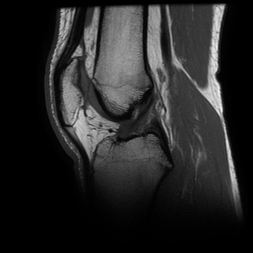 Posterior oblique ligament injury | Image | Radiopaedia.org