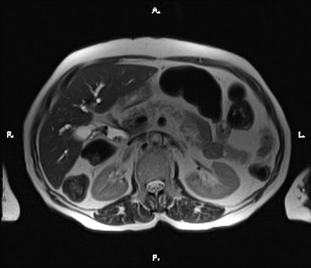 Cholelithiasis And Choledocholithiasis 