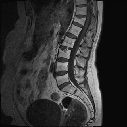 Camptocormia | Radiology Reference Article | Radiopaedia.org