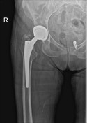 Vancouver classification of periprosthetic hip fractures | Radiology ...