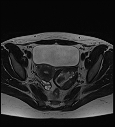 Ruptured ovarian haemorrhagic cyst | Radiology Case | Radiopaedia.org