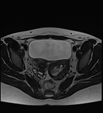 Ruptured ovarian cyst | Radiology Reference Article | Radiopaedia.org